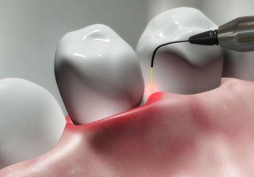 جراحی با لیزر جراحی با لیزر