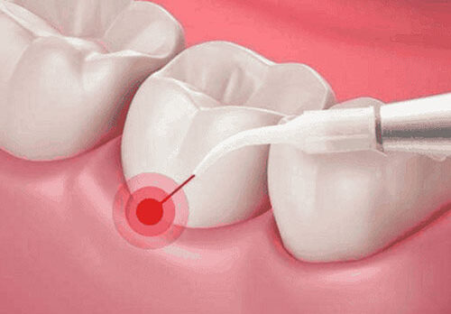 عصب کشی بدون درد با لیزر عصب کشی بدون درد با لیزر