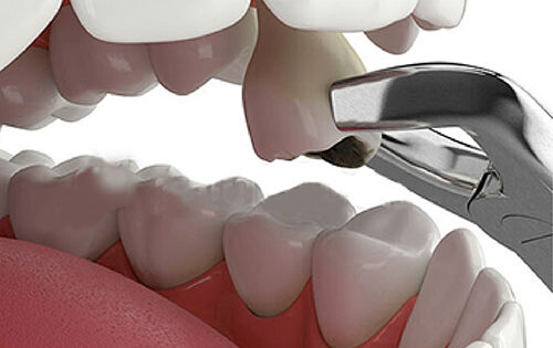 کشیدن دندان کشیدن دندان