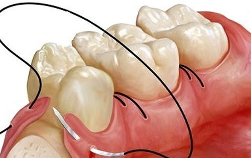 جراحی دندان جراحی دندان