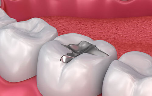 پرکردن دندان پرکردن دندان